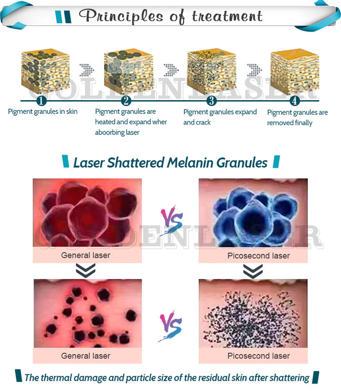 Say Goodbye to Unwanted Hair with 1000W Handle Power Home Laser Hair Removal Device